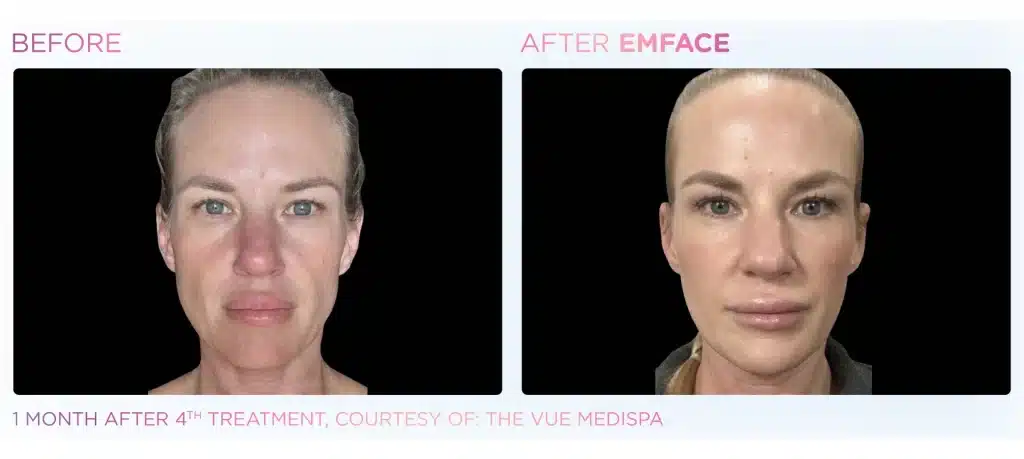 before & after emface treatment of a woman in montclair new jersey at Well in Montclair for Emsella in Montclair, NJ.