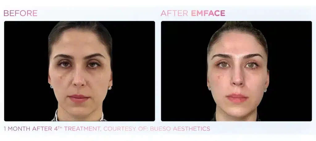 before & after emface treatment of a woman in montclair new jersey at Well in Montclair for Emsella in Montclair, NJ.