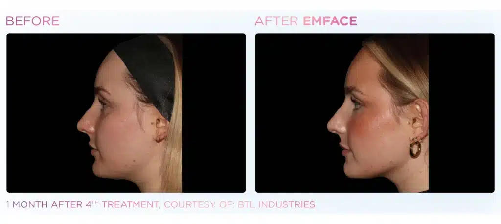 before & after emface treatment of a woman in montclair new jersey at Well in Montclair for Emsella in Montclair, NJ.