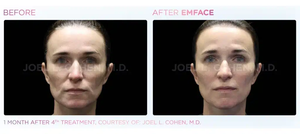 before & after emface treatment of a woman in montclair new jersey at Well in Montclair for Emsella in Montclair, NJ.