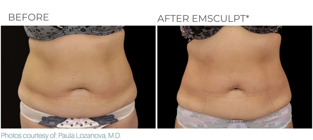 semaglutide first dose what to expect How Long Do You Stay on Semaglutide for Weight Loss? Guide
