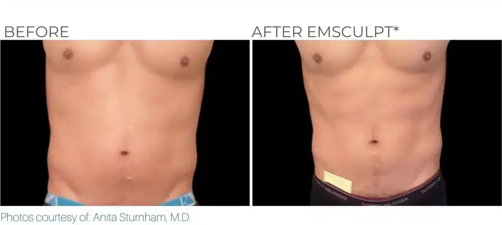 how to put semaglutide in syringe I feel so silly 😂🤯 : r/CompoundedSemaglutide