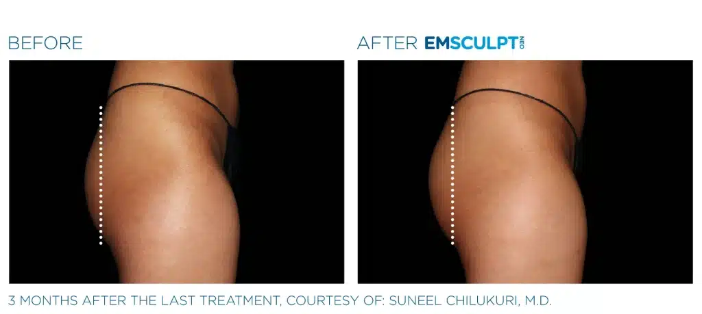 before & after emsculpt neo treatment of a woman in montclair new jersey at Well in Montclair for Emsella in Montclair, NJ.