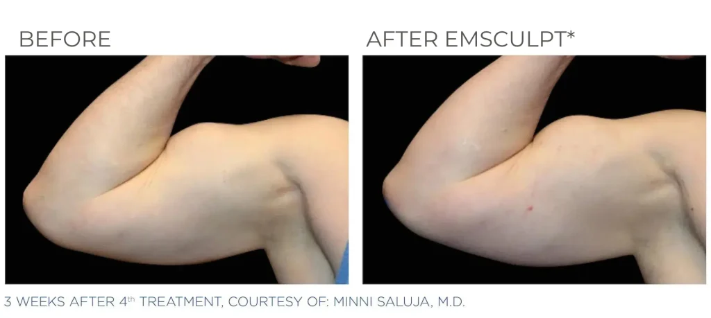 tips for taking semaglutide Semaglutide Injection Sites: Best Locations & Doctor Advice