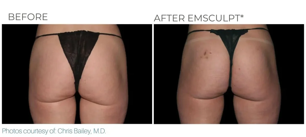 before & after emsculpt neo treatment of a woman in montclair new jersey