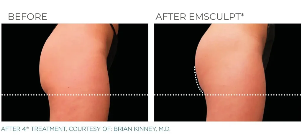 before & after emsculpt neo treatment of a woman in montclair new jersey