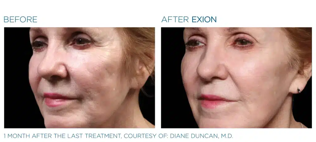 before & after exion treatment of a woman in montclair new jersey