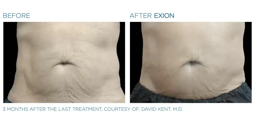 before & after exion treatment of a man in montclair new jersey
