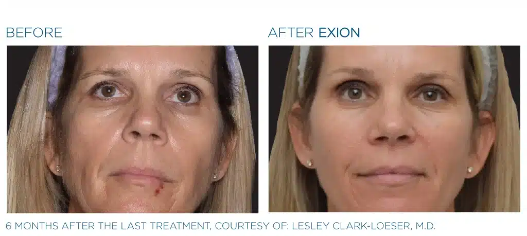 before & after exion treatment of a woman in montclair new jersey