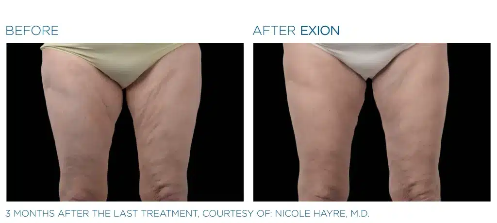 before & after exion treatment of a woman in montclair new jersey