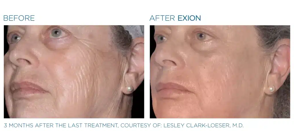 before & after exion treatment of a woman in montclair new jersey