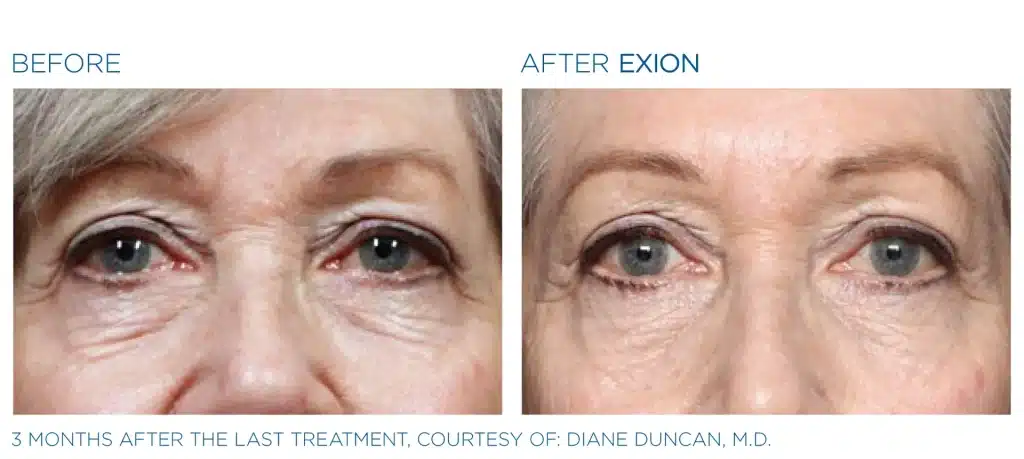 before & after exion treatment of a woman in montclair new jersey