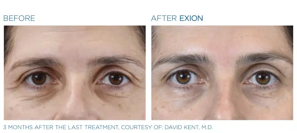 before & after exion treatment of a woman in montclair new jersey