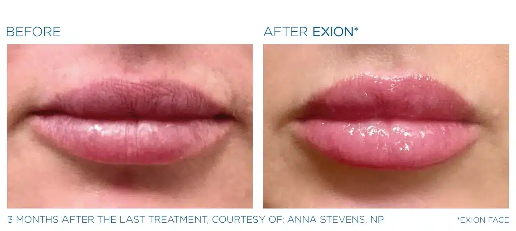 before & after exion treatment of a woman in montclair new jersey