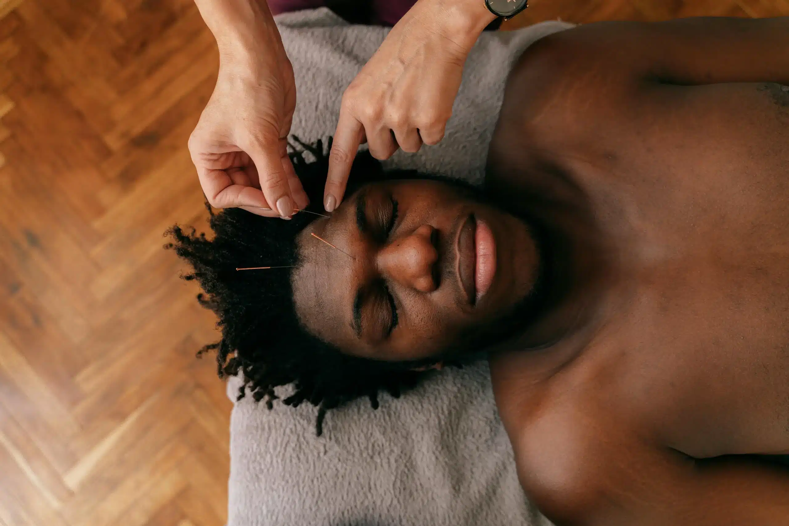 A man is lying peacefully on a soft surface while receiving acupuncture on the forehead. This calming scene shows how acupuncture and the microbiome can work together to support relaxation, balance, and overall health.