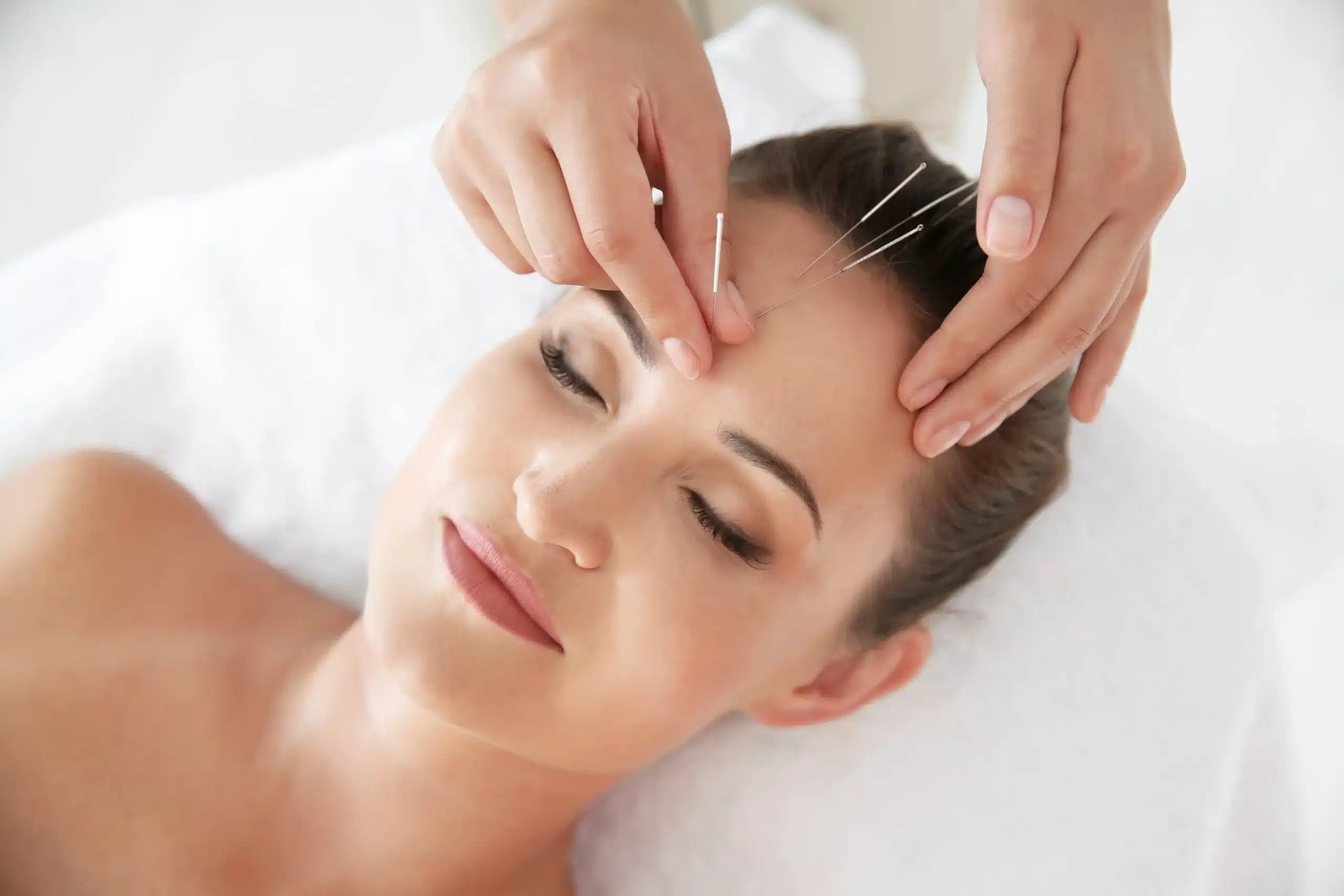 A woman receiving facial acupuncture with forehead needles, supporting acupuncture for women’s health.