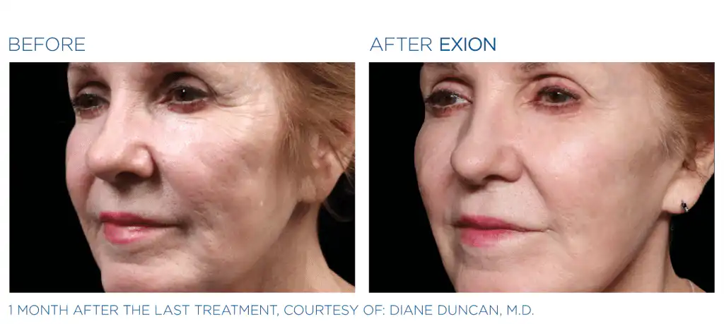 Exion Before and After Photo 1