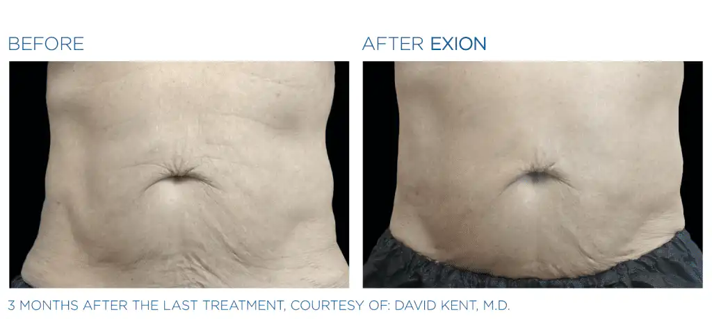 Exion Before and After Photo 4