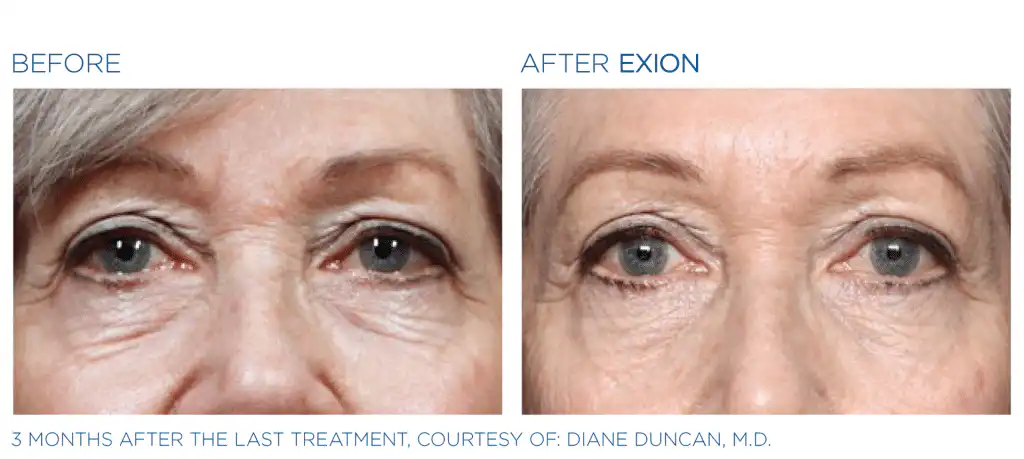Exion Before and After Photo 2