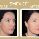 The Emface Before and After image shows a side-by-side comparison of a woman’s face highlighting the results of an Emface treatment in Montclair, NJ. In the before photo, her facial contours appear slightly less defined, with mild skin laxity and softer cheek structure. In the after photo, her skin looks noticeably smoother and firmer, with more lifted cheeks and improved overall facial tone.