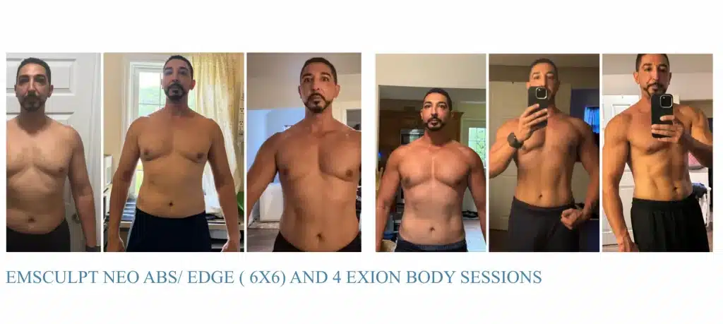 exion before and after results in montclair nj